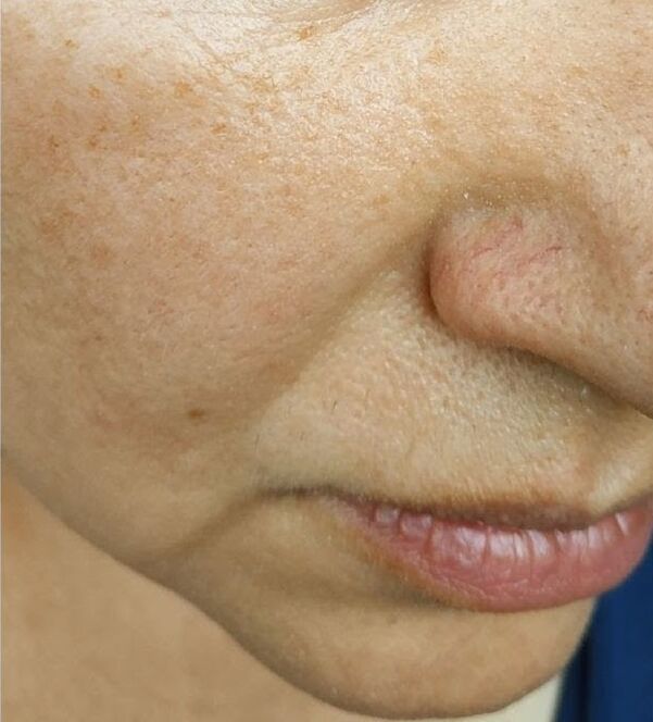 At 40, the nasolabial folds appeared