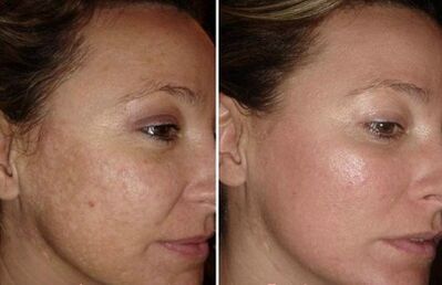 Laser skin rejuvenation before and after photo