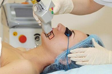 Laser skin rejuvenation type